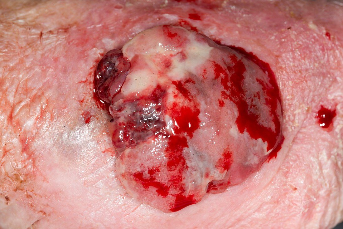 Pyogenic granuloma