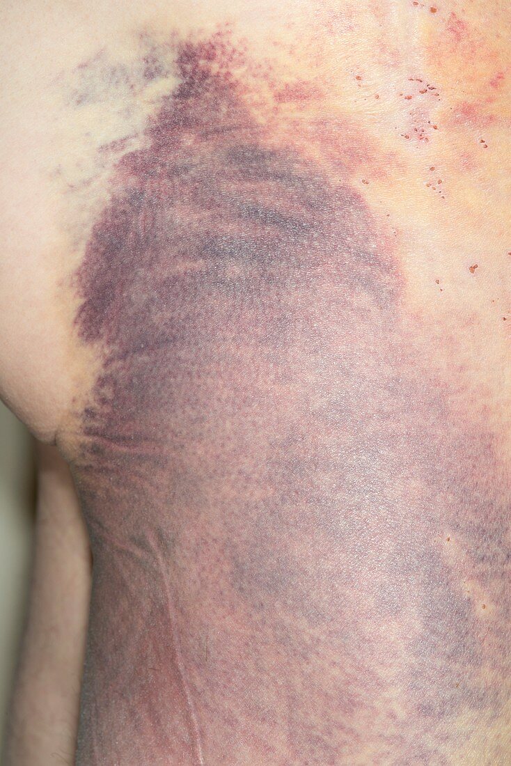 Bruising after an accident