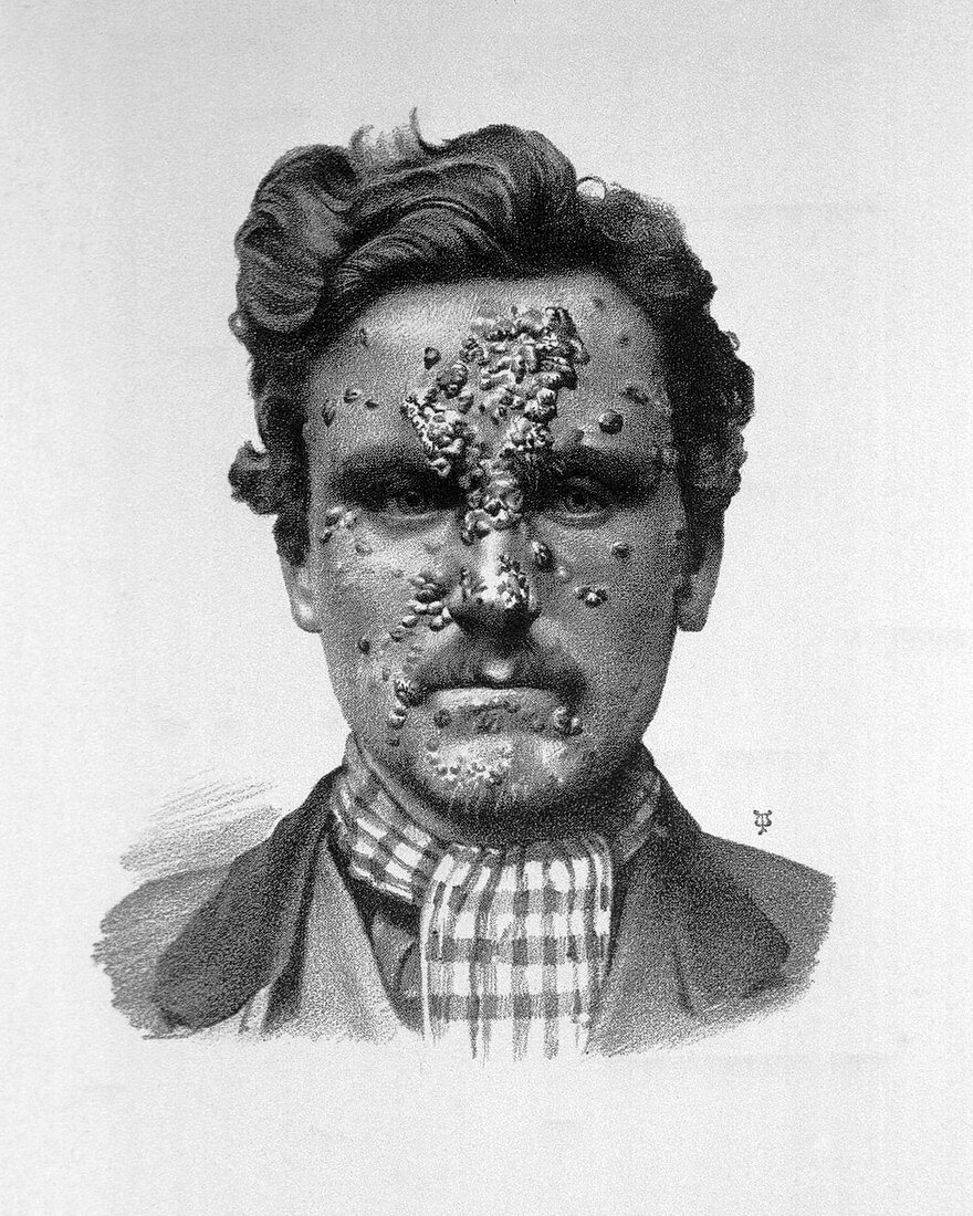 Secondary syphilis,19th century