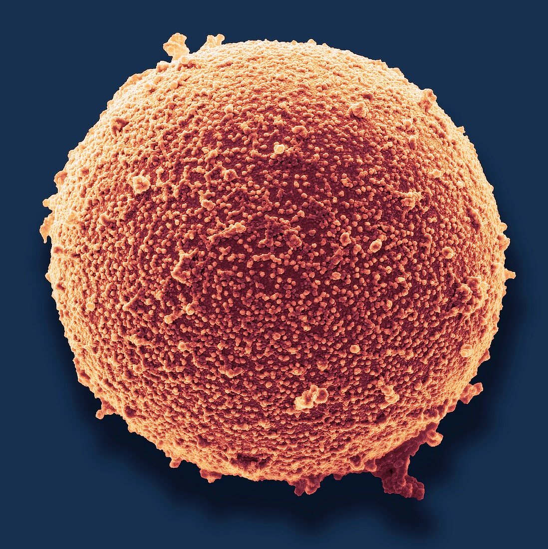 Immature germ cell in semen,SEM