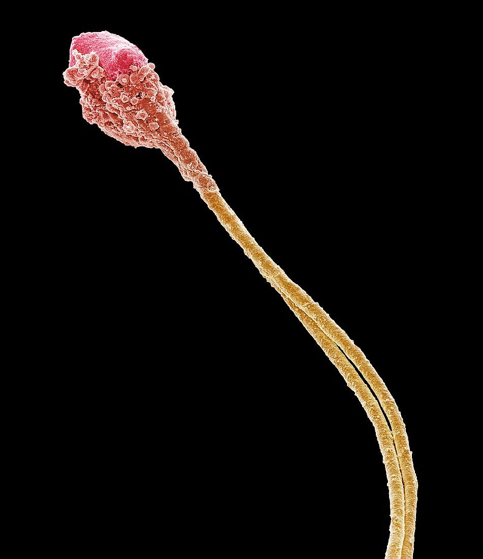 Abnormal human sperm cell,SEM