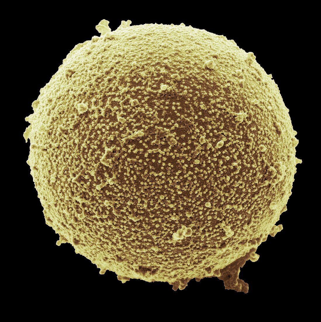 Immature germ cell in semen,SEM