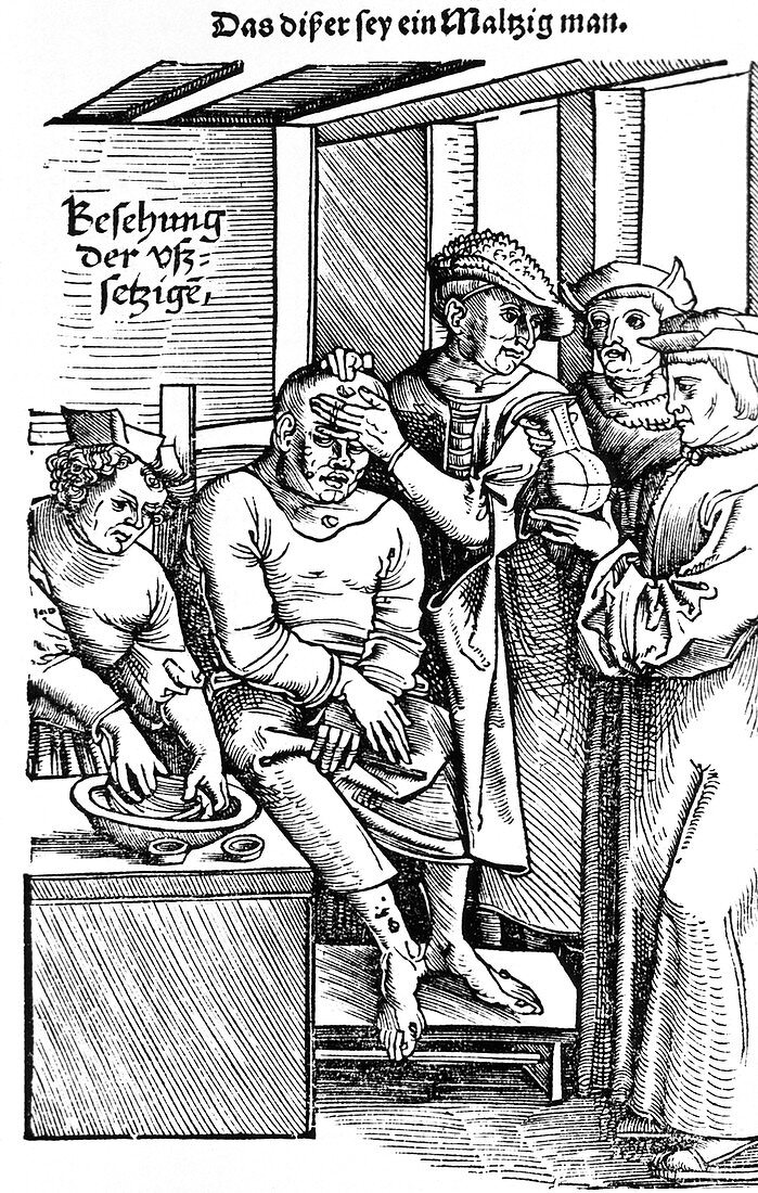 Leprosy diagnosis,16th century