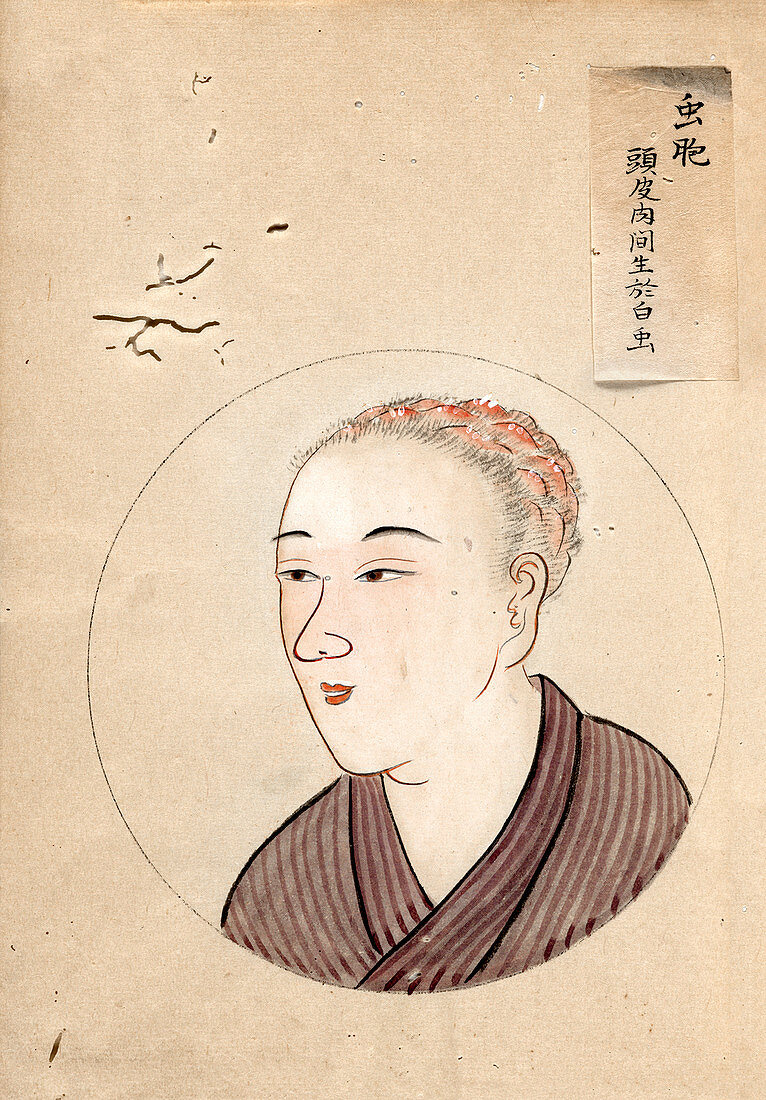Head lice patient,19th-century Japan