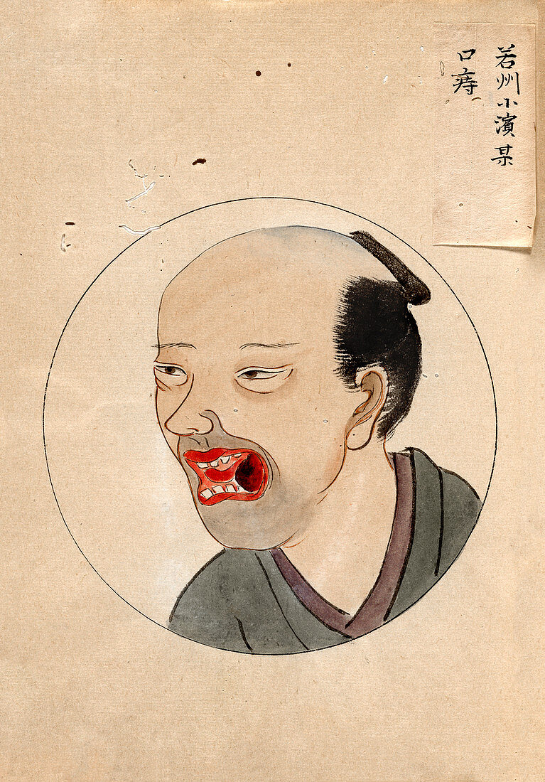 Oral cancer patient,19th-century Japan
