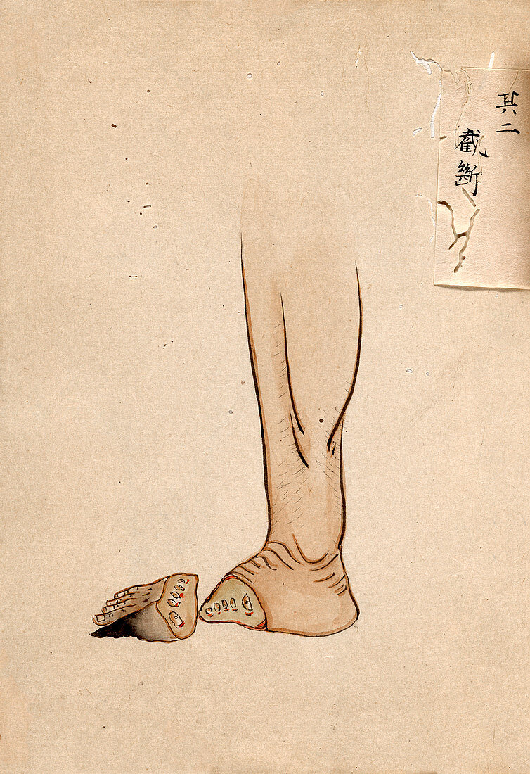 Gangrene amputation,19th-century Japan