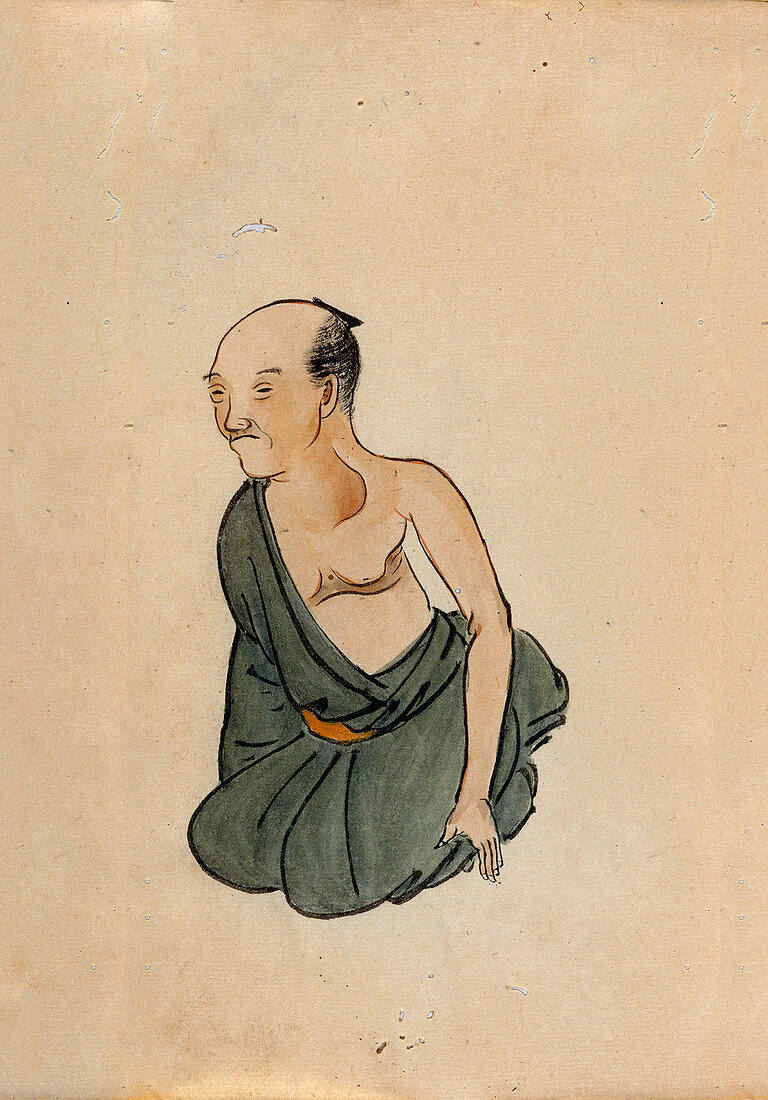 Chest cancer patient,19th-century Japan