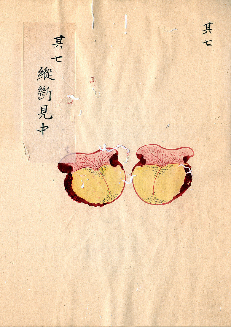 Excised breast cancer,19th-century Japan