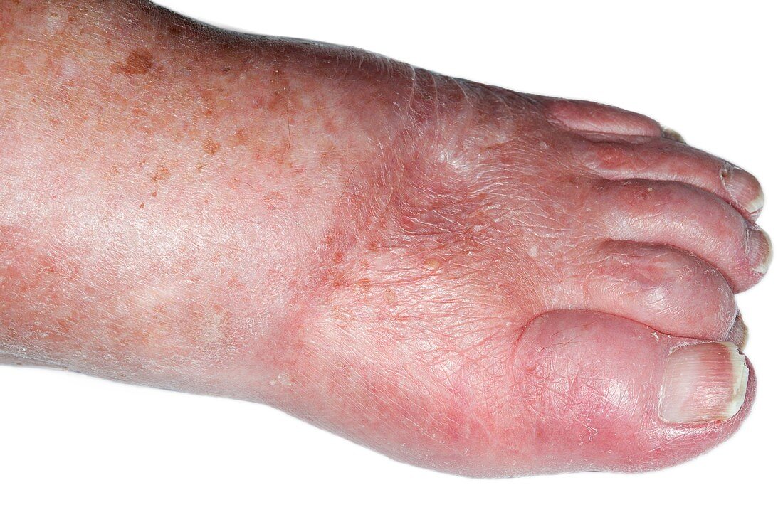 Foot oedema