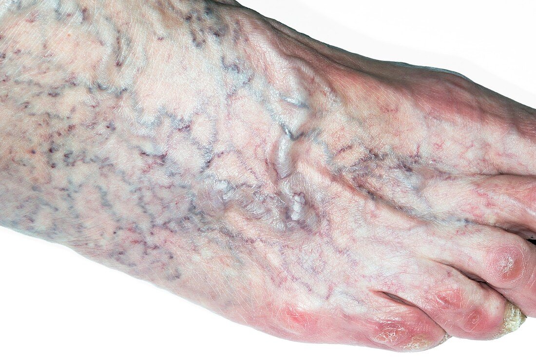 Varicose veins