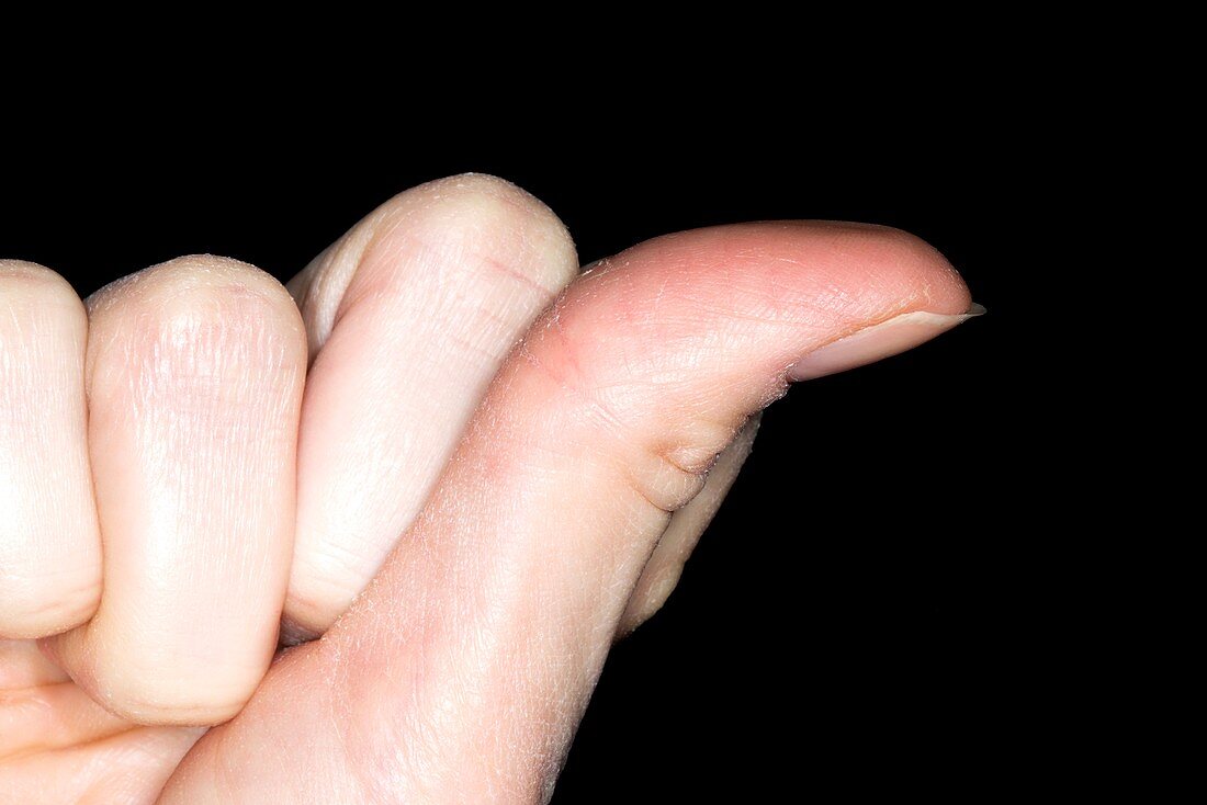Hyperextensive thumb