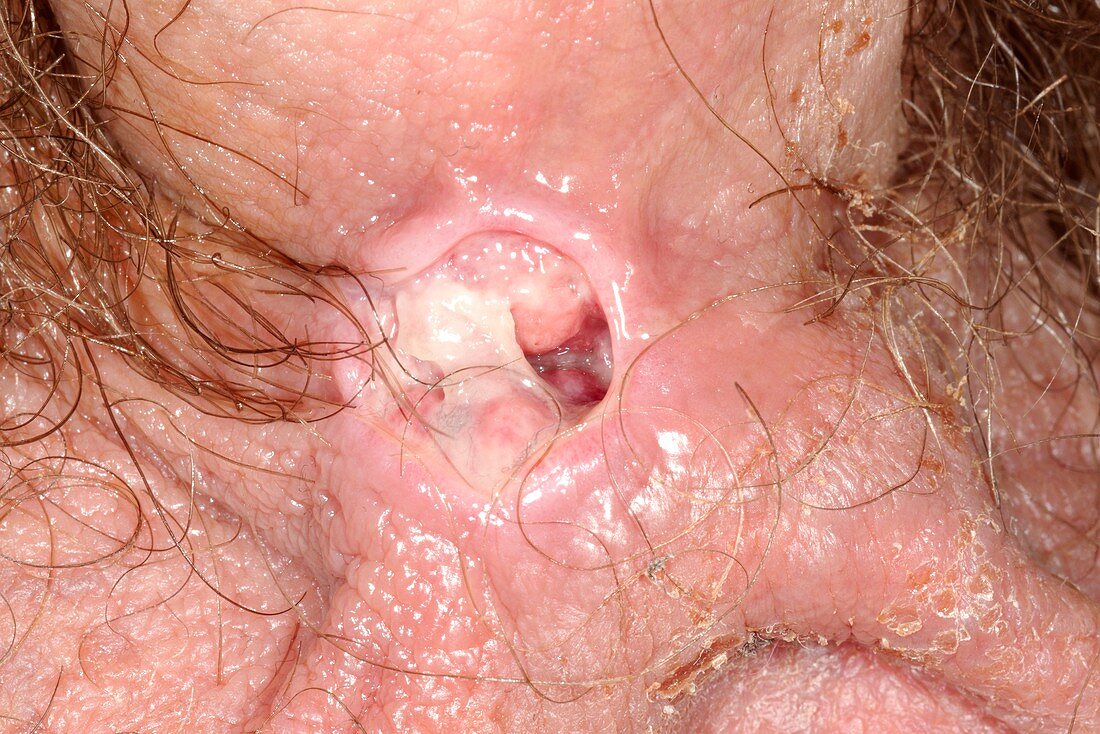 Infected vasectomy wound