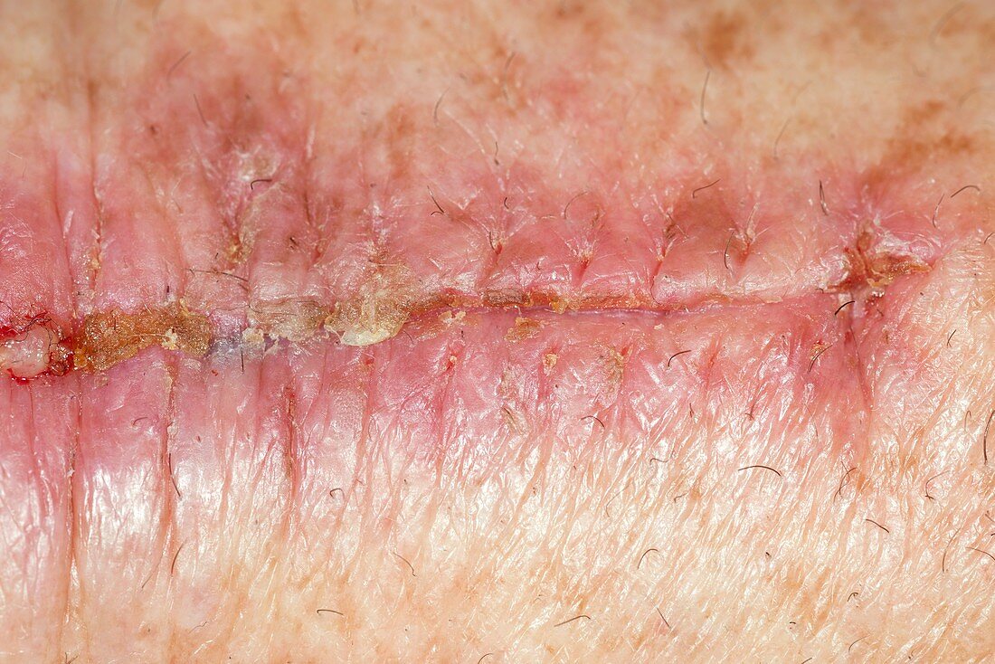 Skin cancer surgery scar