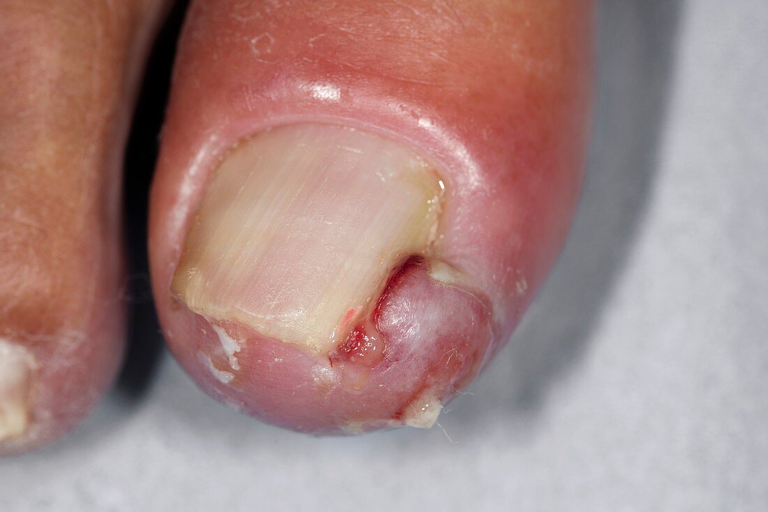Granulation tissue over toenail