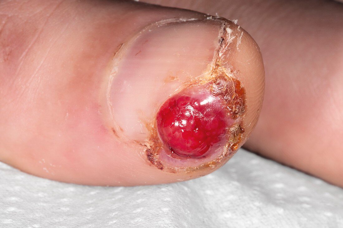 Granulation tissue on thumb wound