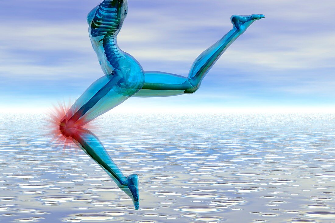 Knee Injury,illustration