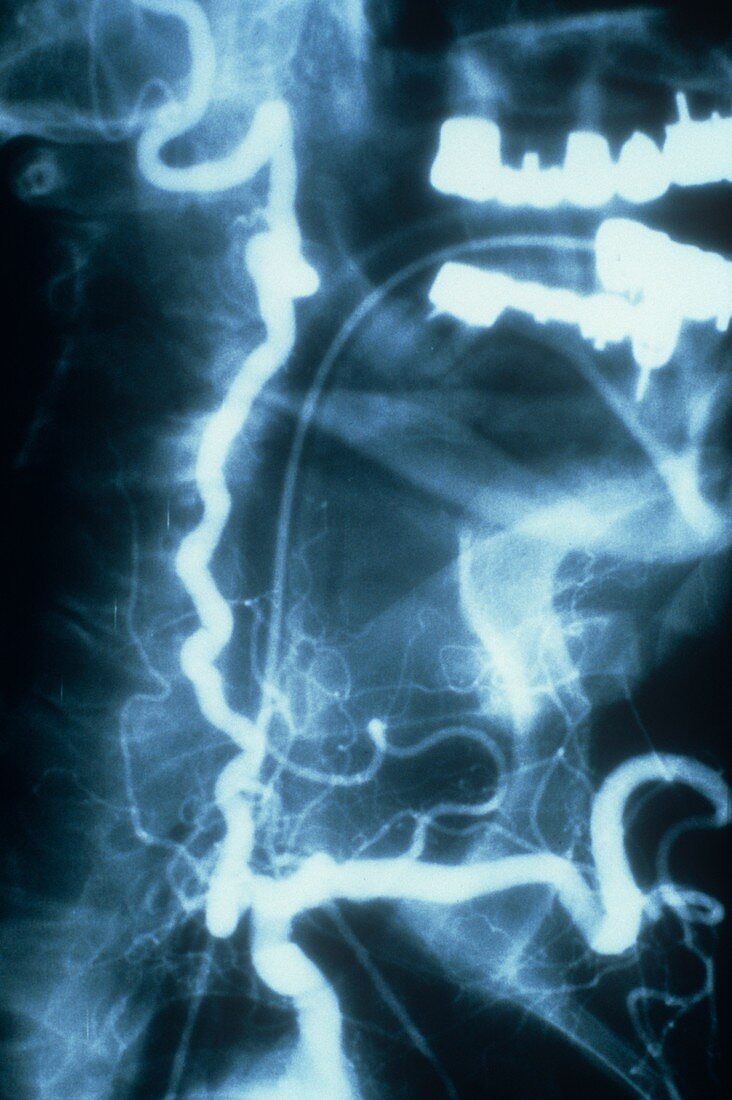 Ischaemia in fibromuscular dysplasia