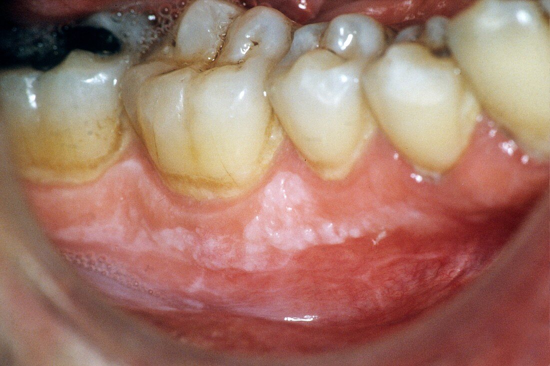Leukoplakia of the gums