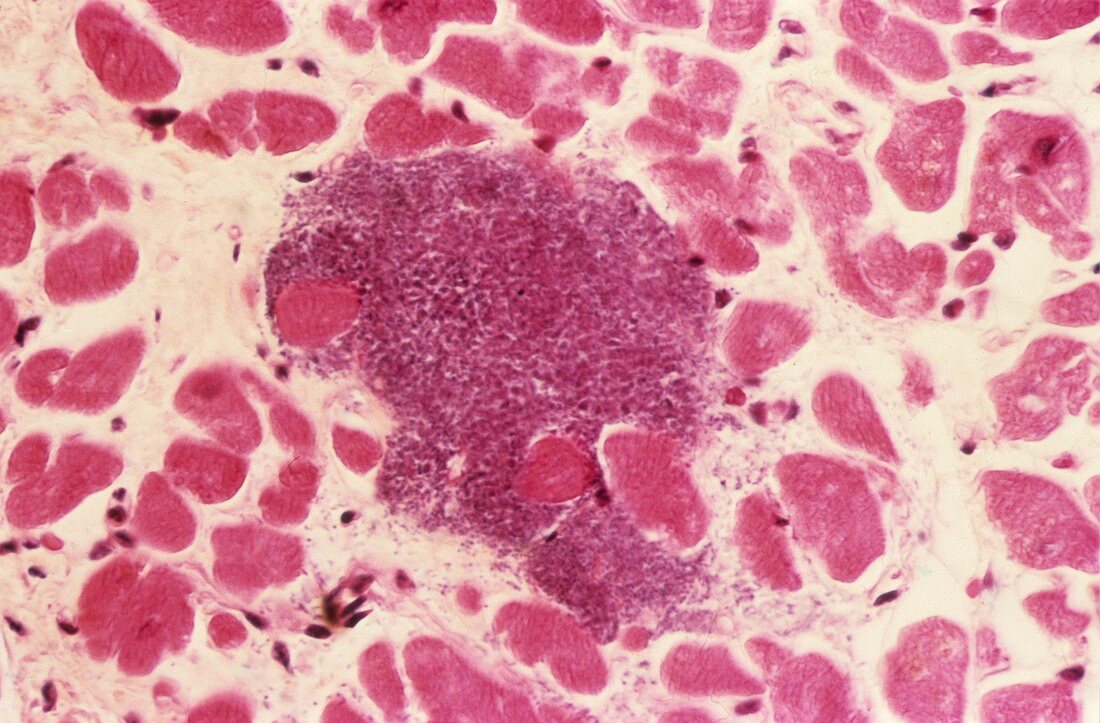 Infective myocarditis,light micrograph