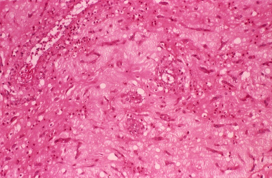 Heart tumour,light micrograph