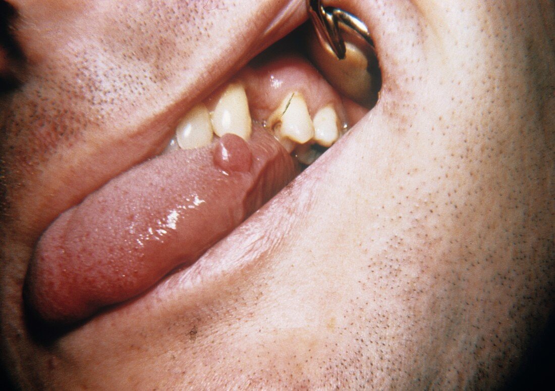Tongue tumour