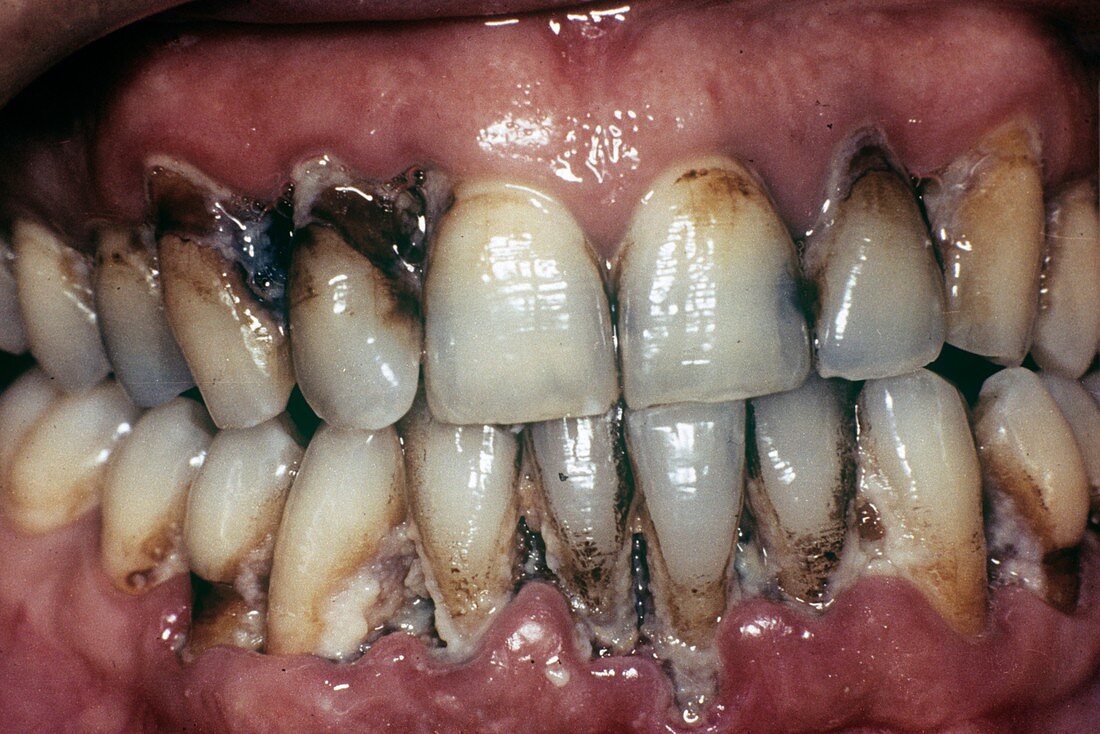 Dental tartar,plaque and gum disease