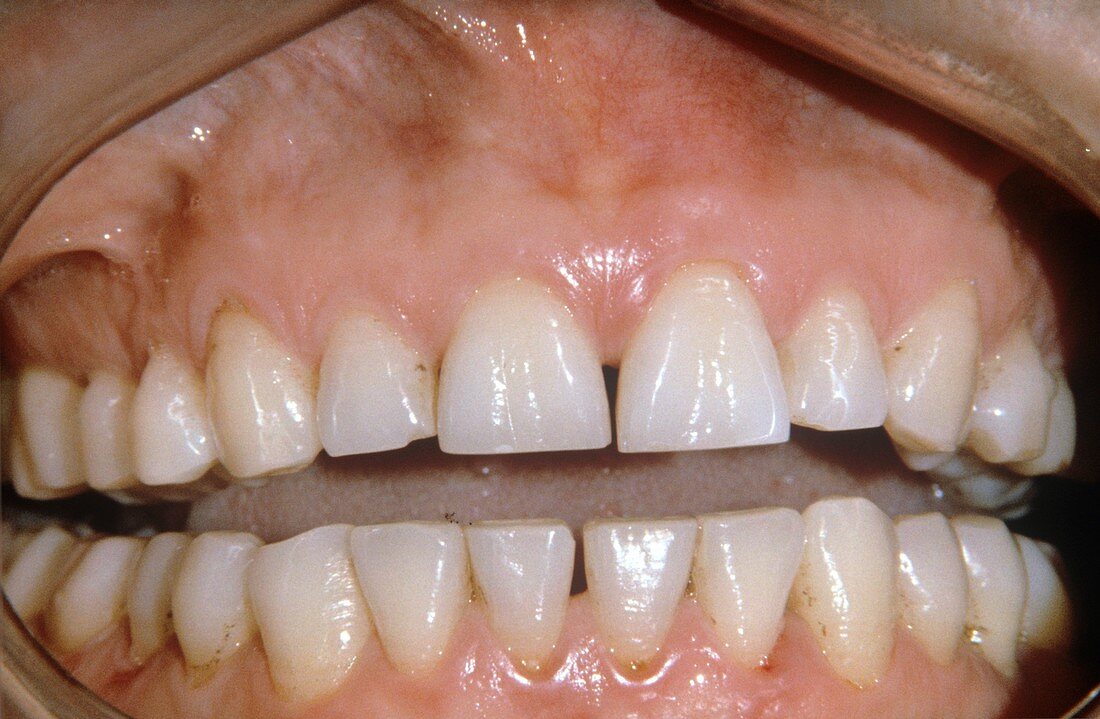 Dental abrasion