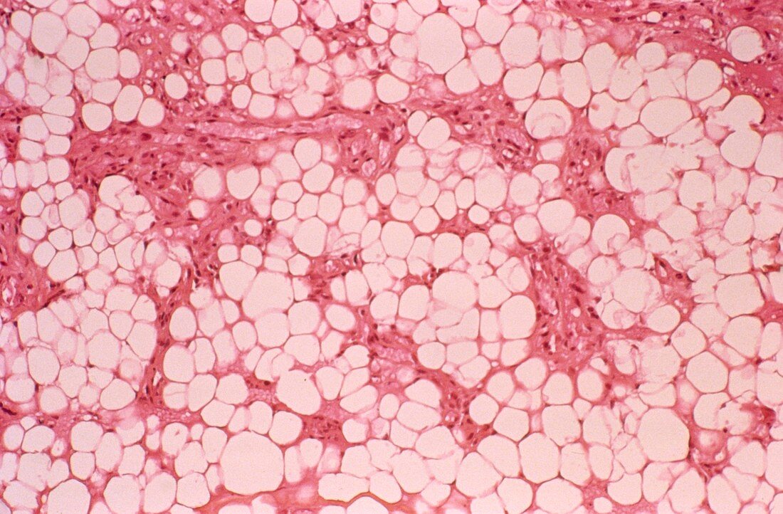 Lipoma,light micrograph