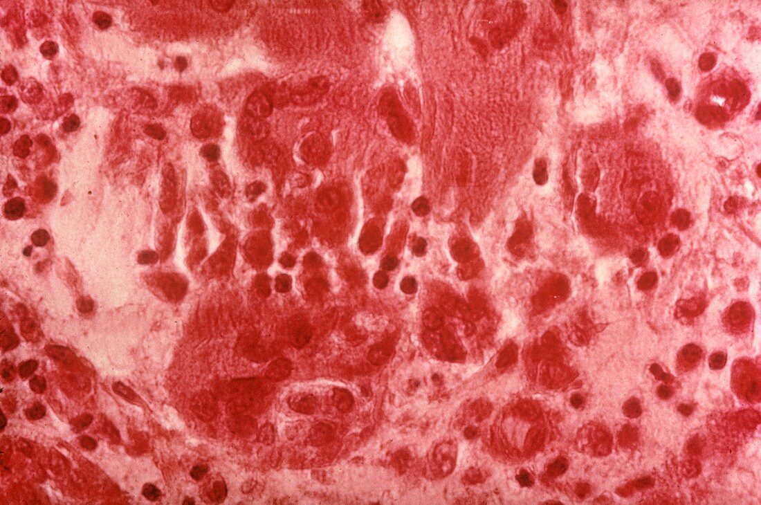 Granuloma,light micrograph