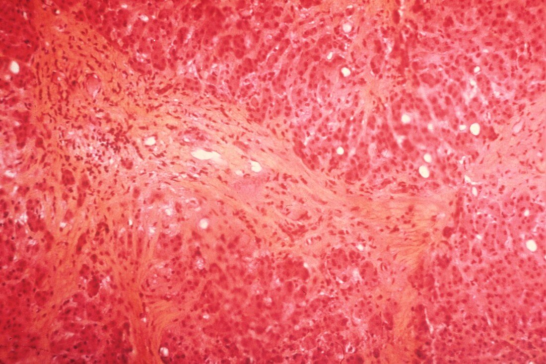 Liver in kwashiorkor,light micrograph