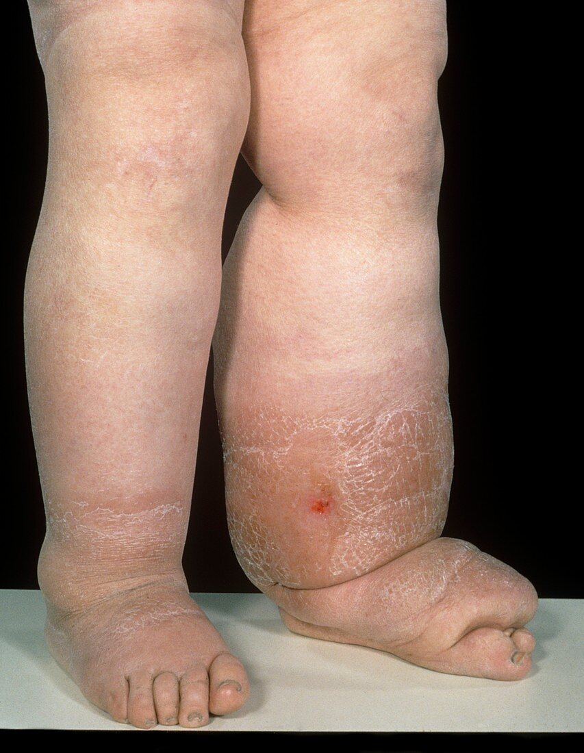 Lymphoedema of the legs
