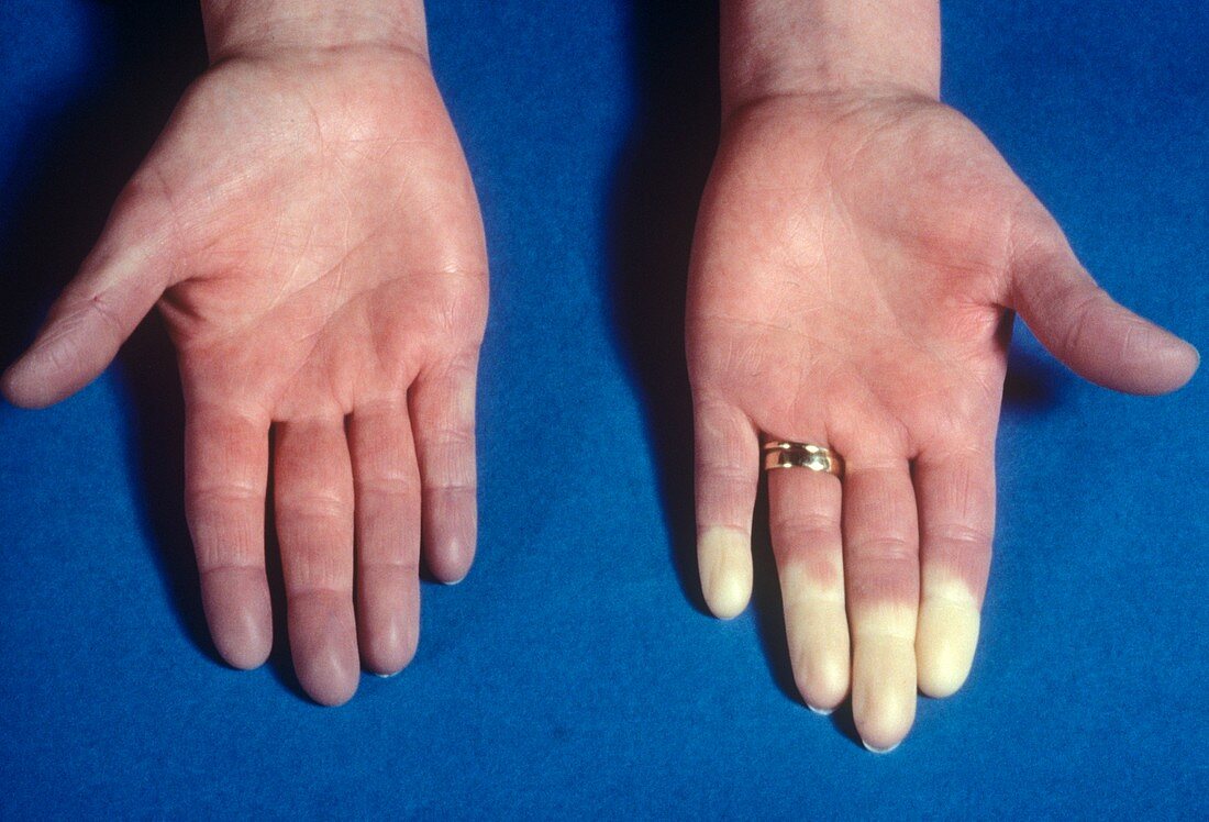 Raynaud's phenomenon in the fingers
