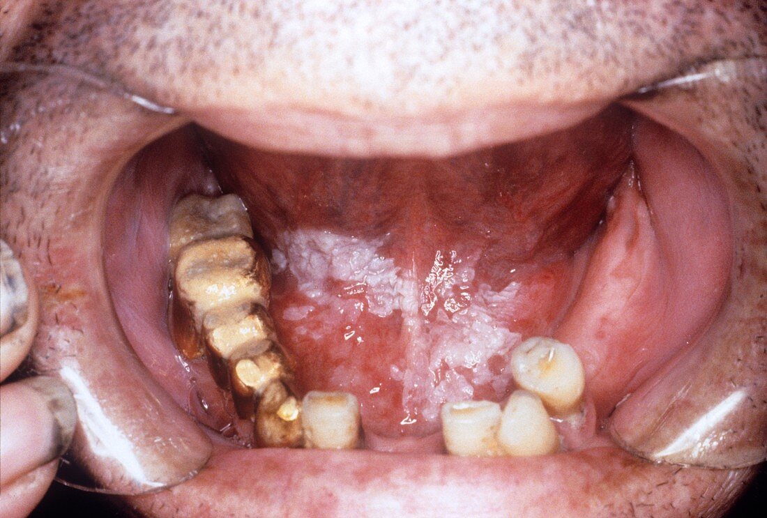 Leukoplakia of the mouth