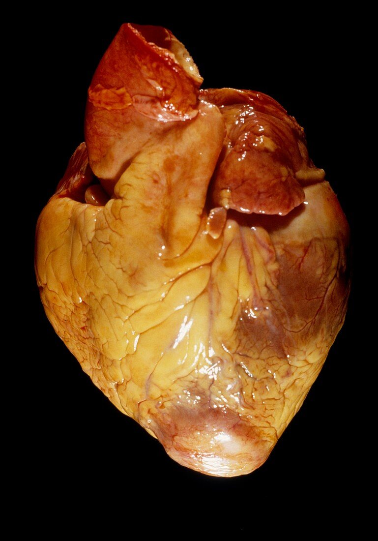 Cardiac amyloidosis