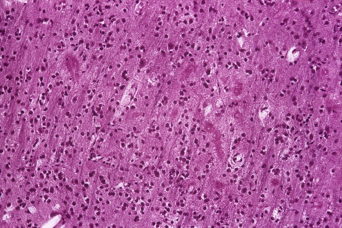 Brain in dementia,light micrograph