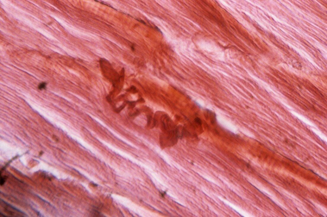 Muscle in Cushing's syndrome,micrograph