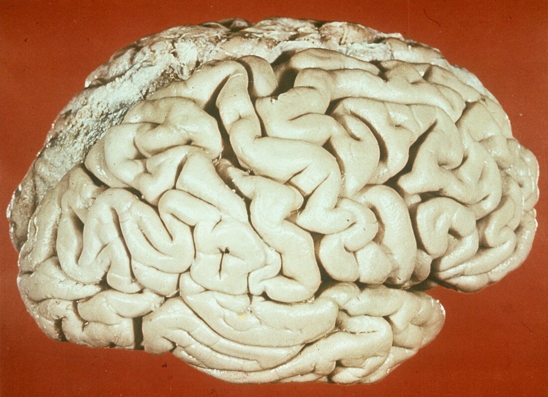 Brain in Sturge-Weber syndrome