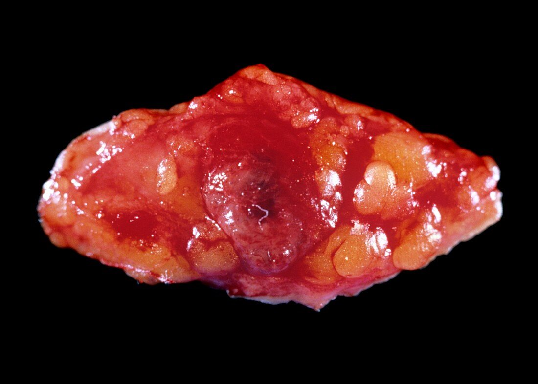 Glomus tumour
