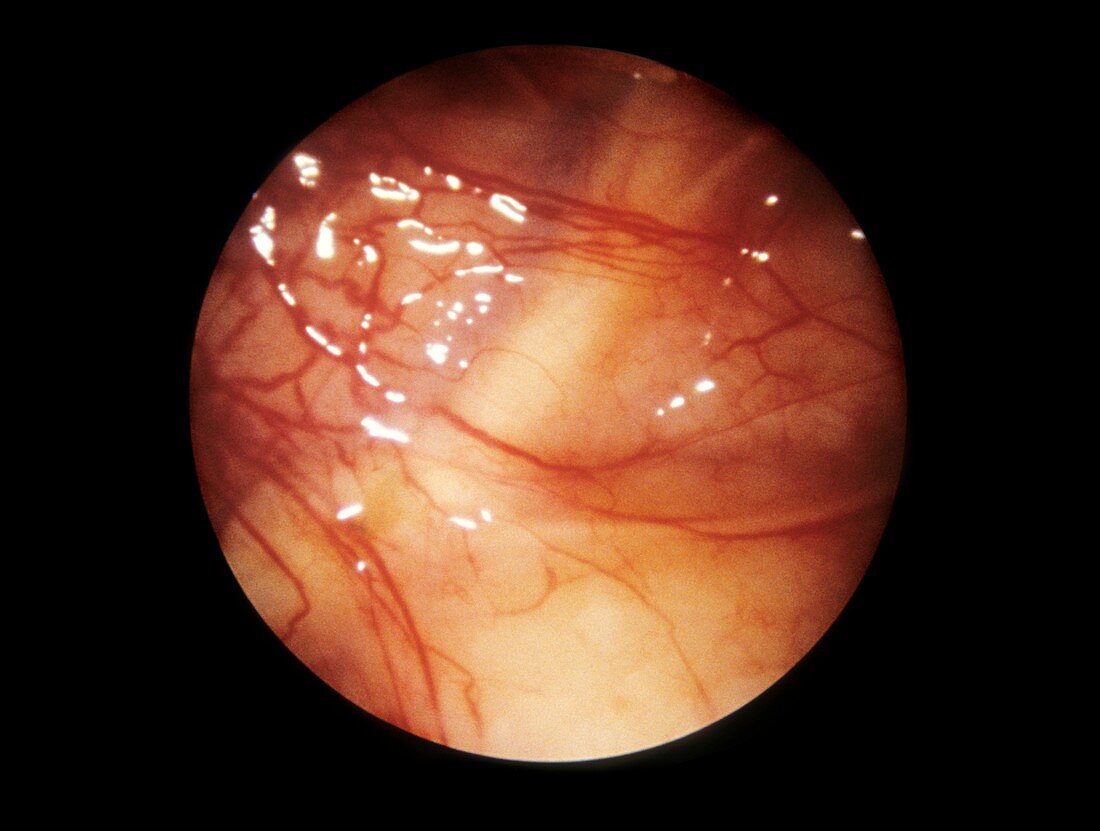 Maxillary sinus and nerve