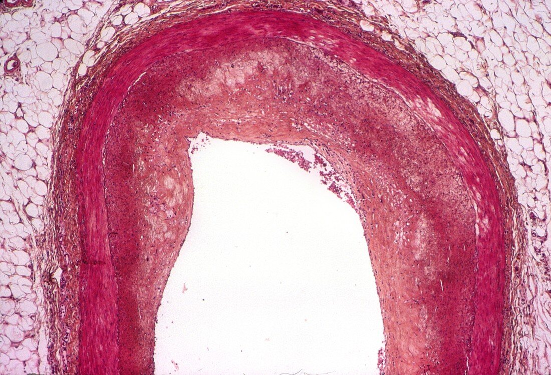 Atherosclerosis,light micrograph