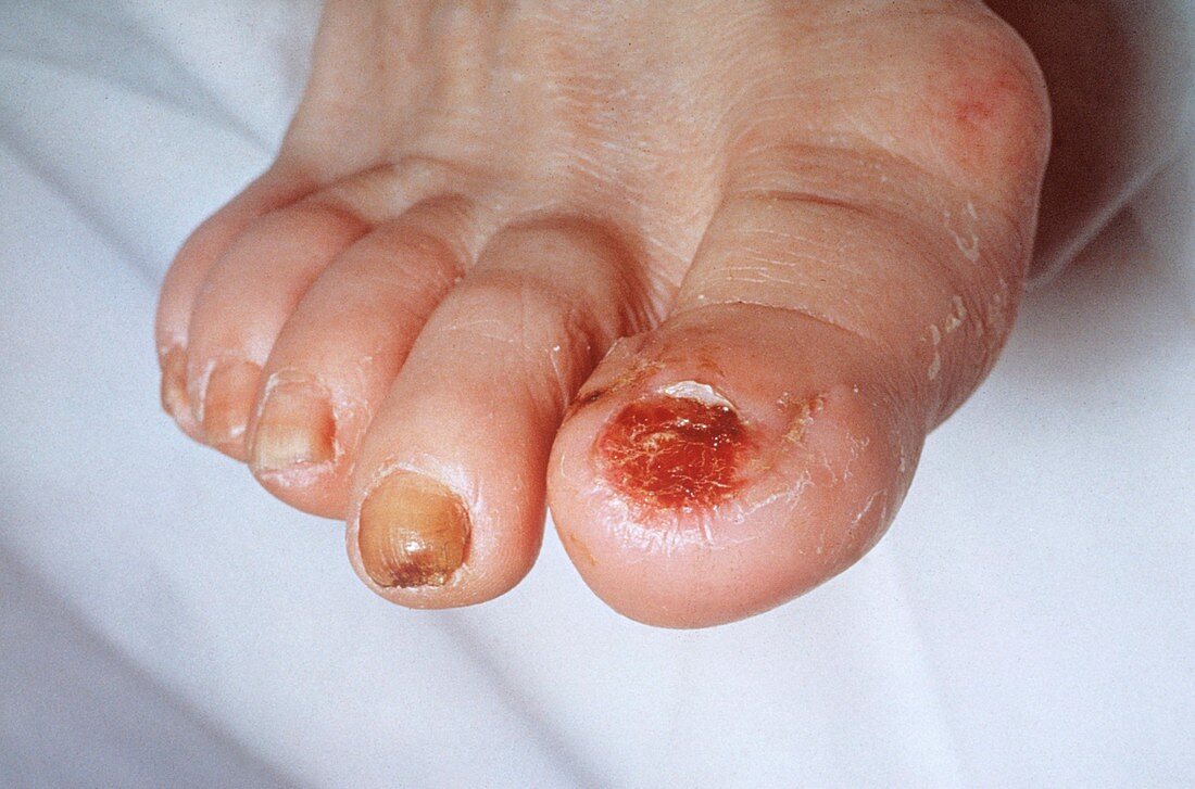 Gangrenous big toe