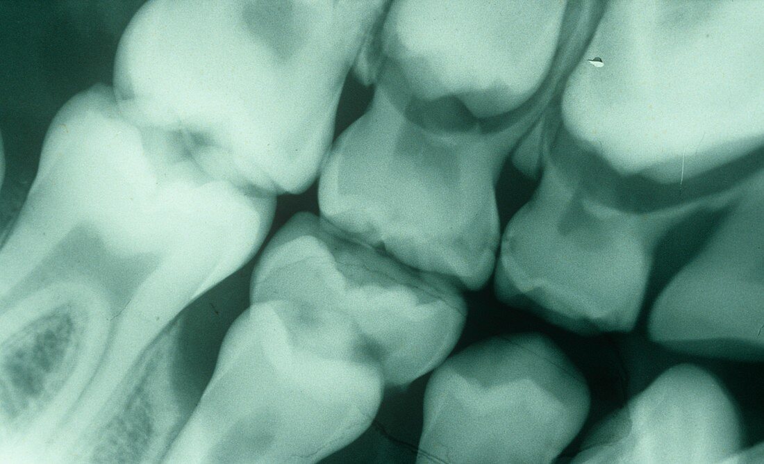 Dental X-ray,6-year-old child