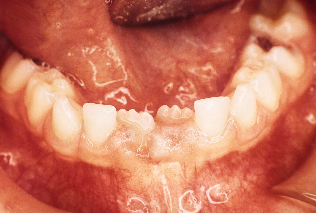 New teeth erupting,7-year-old child