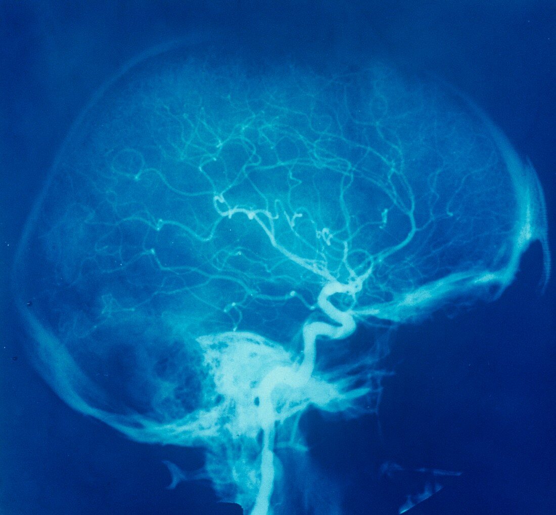 Blood supply to the head,X-ray