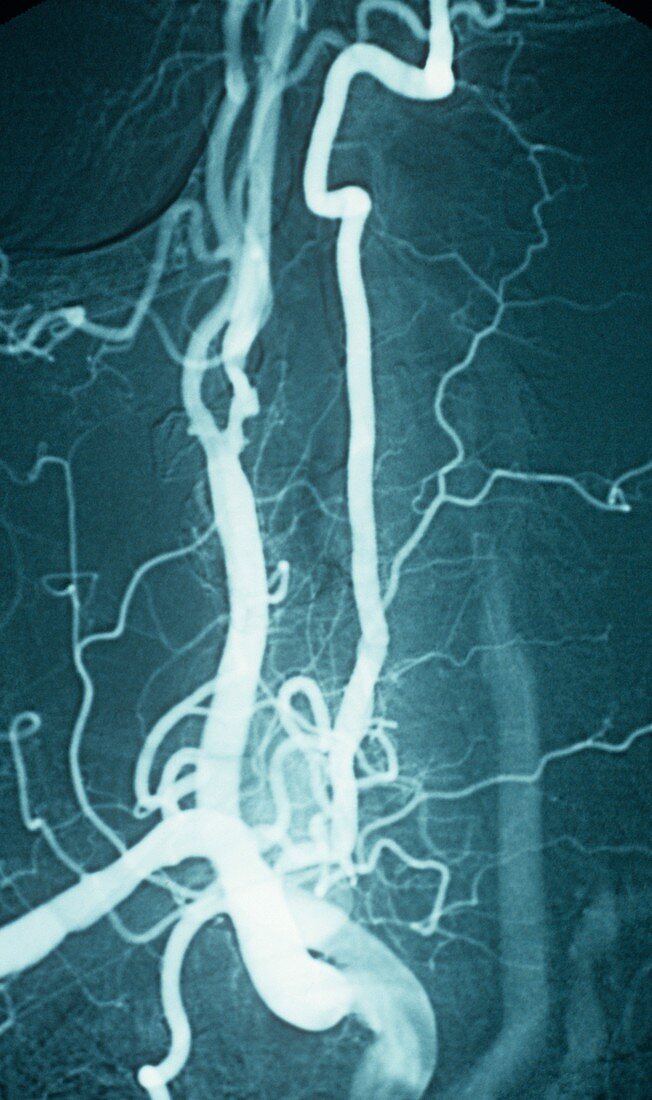 Carotid atherosclerosis,X-ray