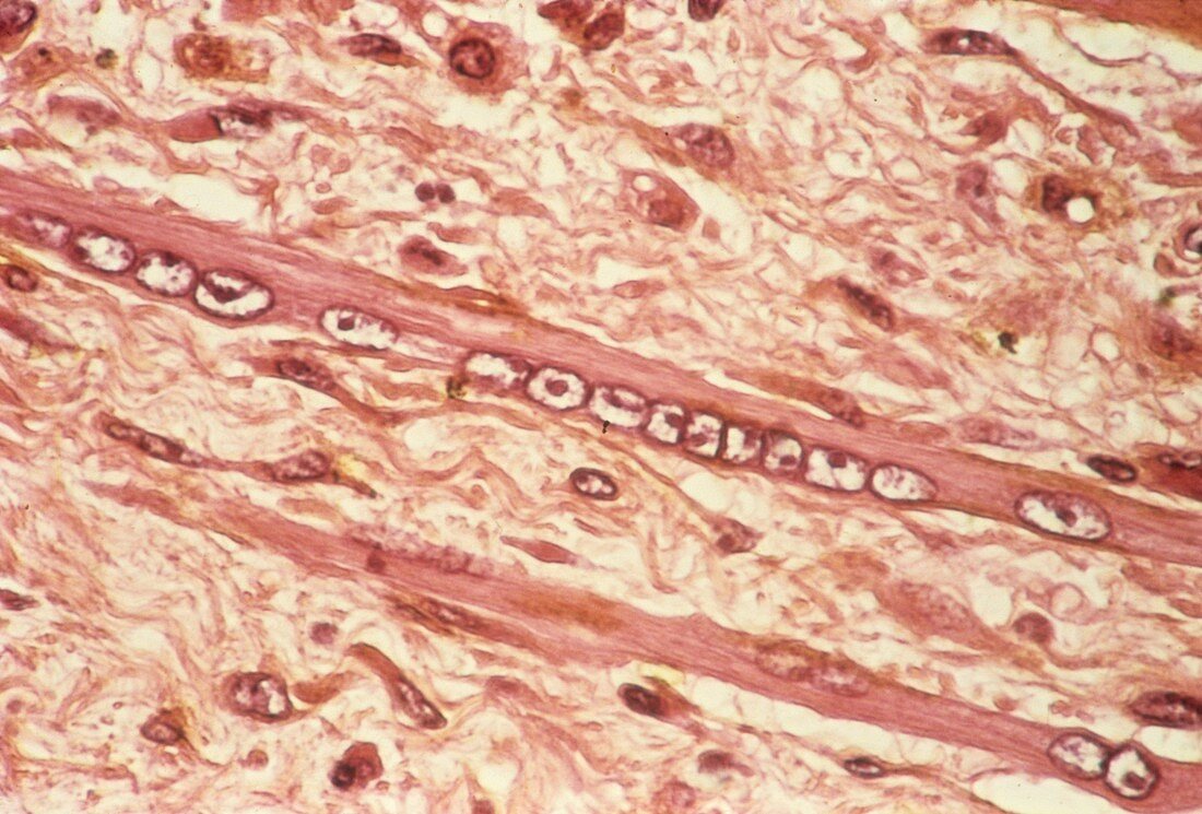 Muscle wasting in cancer,micrograph