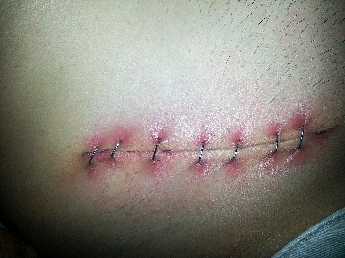 Metal sutures (Metal staples)