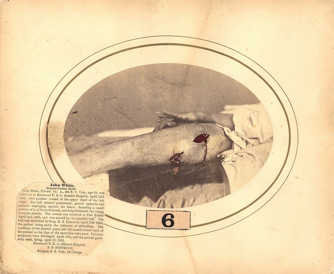 Gunshot wound,1865