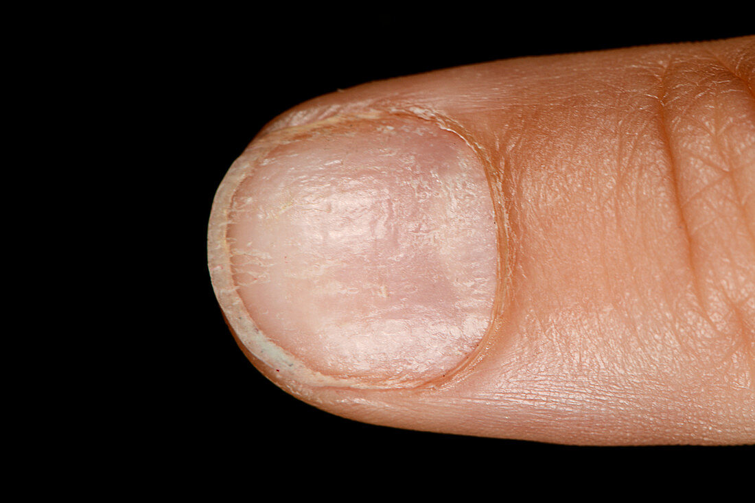 Fingernail psoriasis