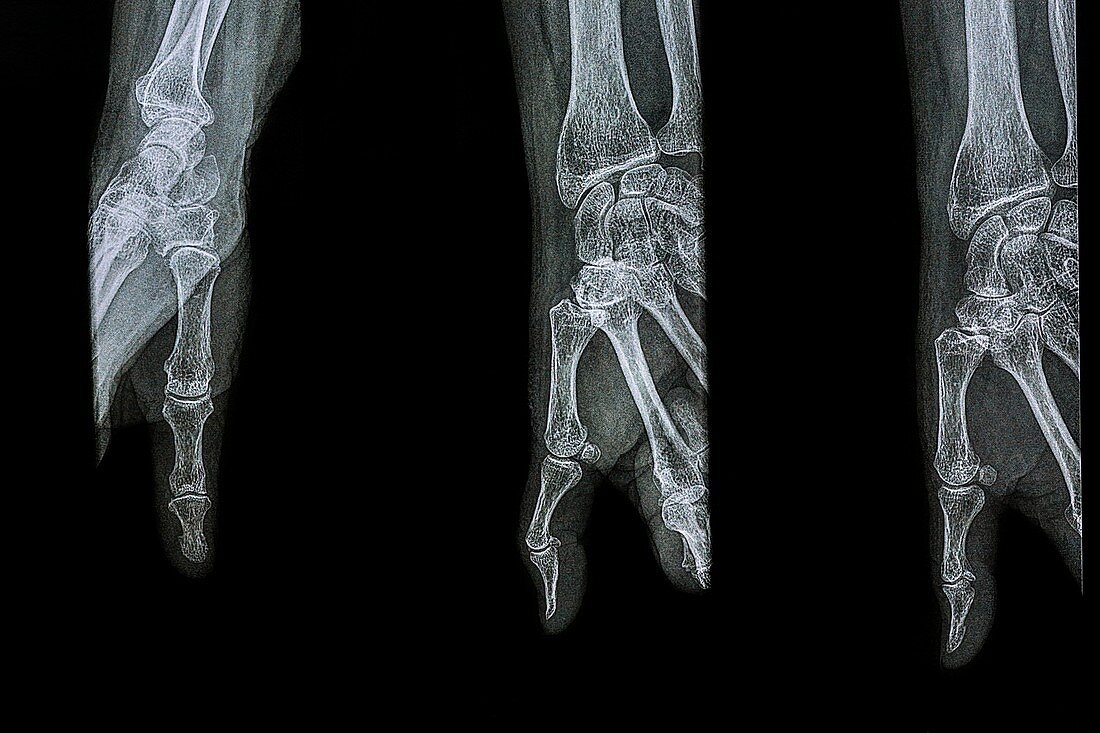 Diagnostic thumb X-rays